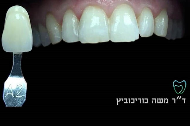 אחרי הלבנת שיניים