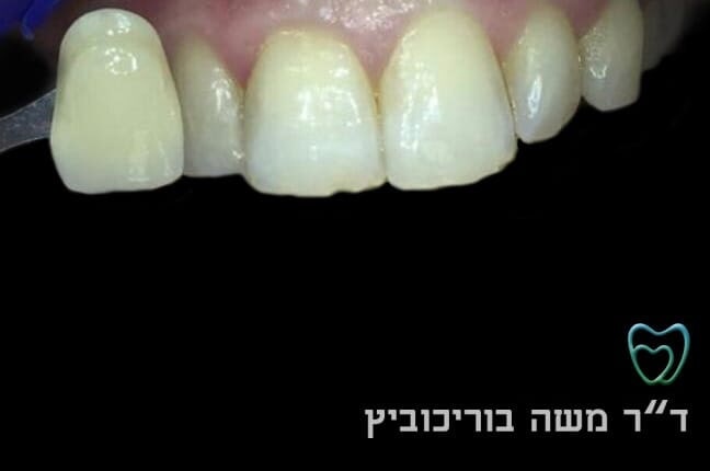 לפני הלבנת שיניים 