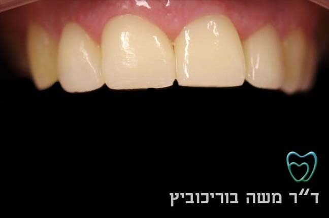 אחרי ציפוי חרסינה 