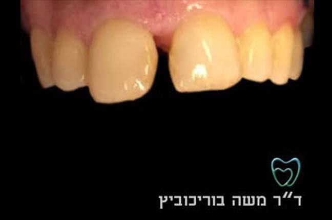 לפני ציפוי חרסינה