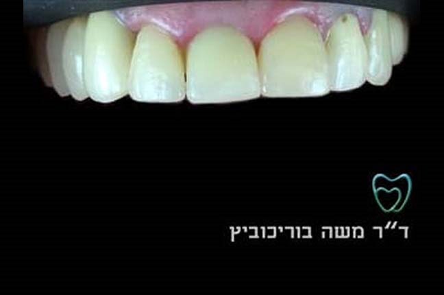 אחרי ציפוי חרסינה 