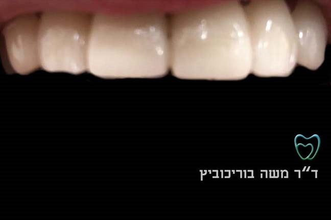 אחרי ציפוי חרסינה 