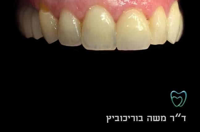 אחרי ציפוי חרסינה 