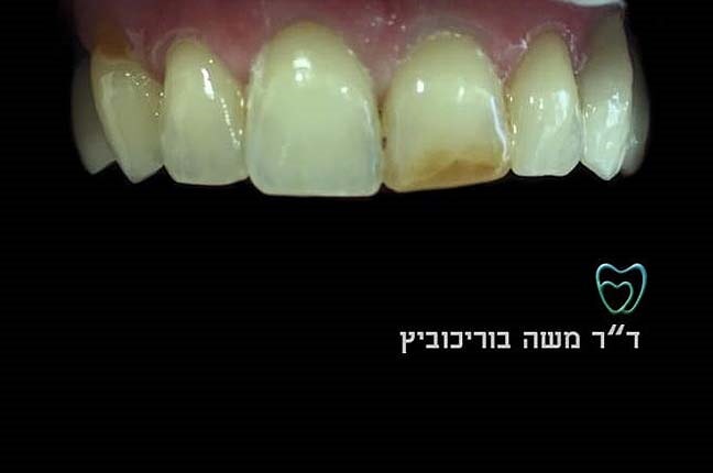 לפני ציפוי חרסינה