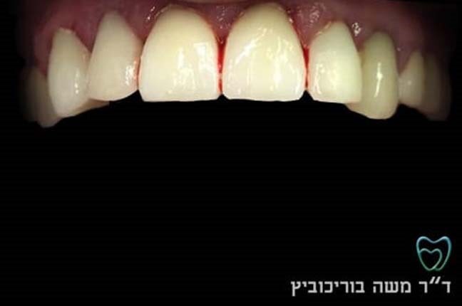 אחרי ציפוי חרסינה 