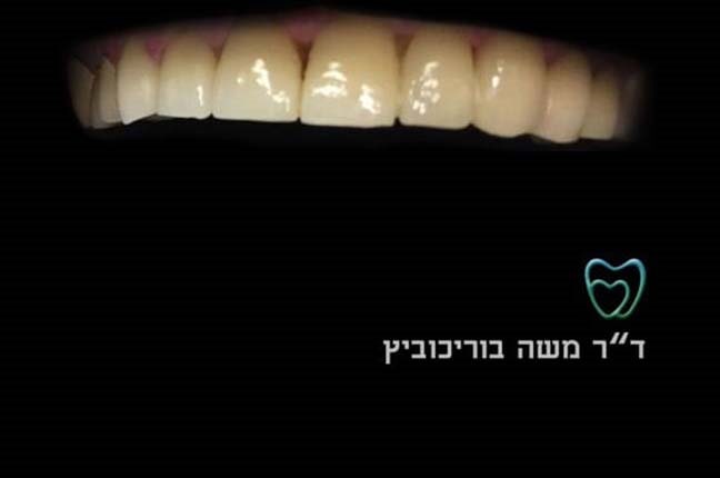 אחרי ציפוי חרסינה 