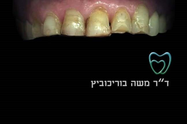 לפני ציפוי חרסינה 