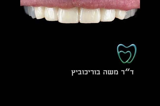 אחרי ציפוי חרסינה 