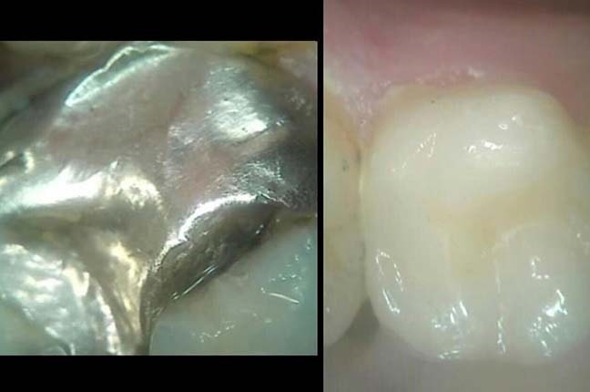 אחרי הלבנת שיניים